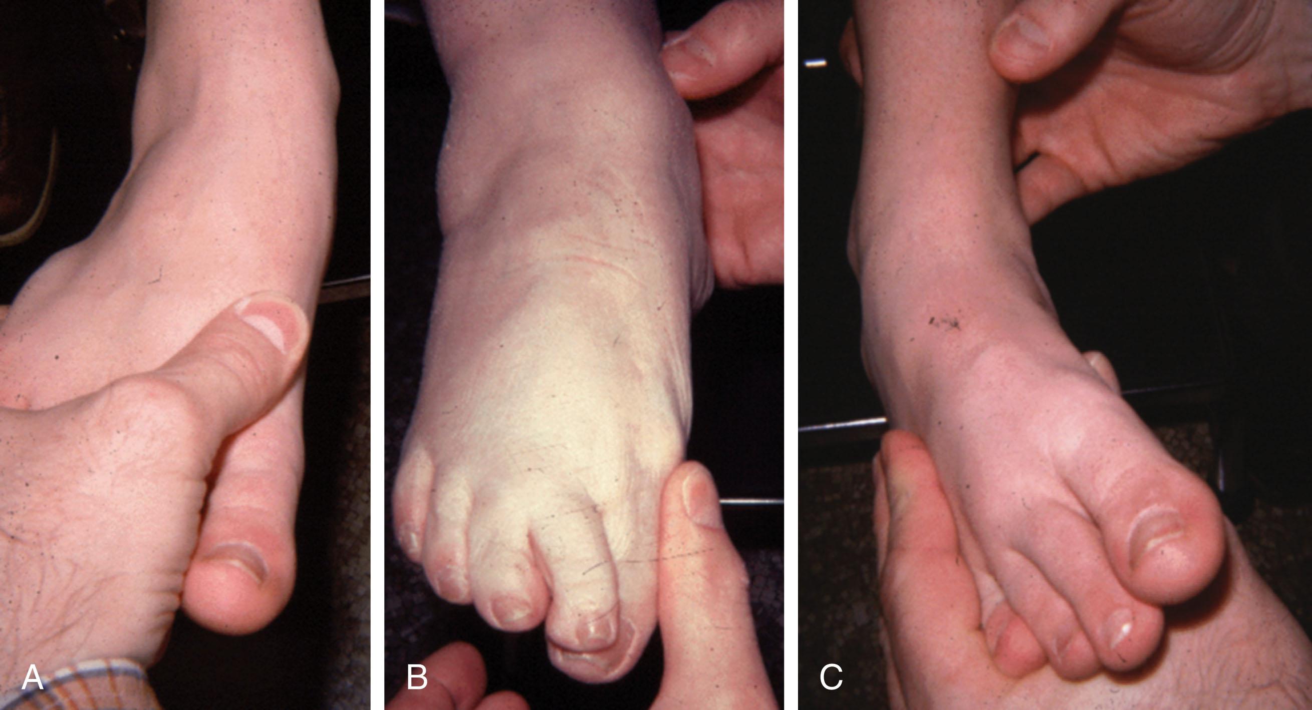 Fig. 2-5, Examination of the posterior tibial tendon. A , The foot is plantar flexed and abducted to neutralize the pull of the anterior tibial tendon. B , The posterior tibial tendon is palpated. C , The patient attempts to adduct the foot, and the strength of the posterior tibial tendon is assessed.