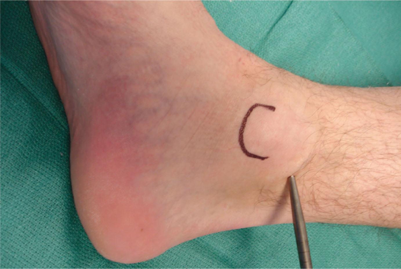 Fig. 2-6, The posterior tibial artery pulse is best felt 2 cm from the malleolar tip.