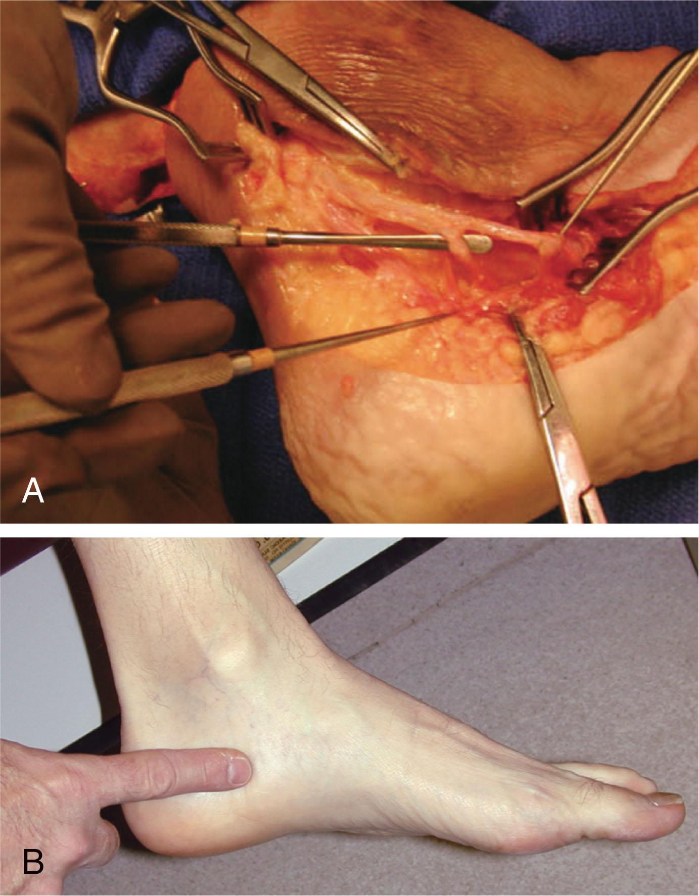 Fig. 2-7, A , Anatomic specimen demonstrating the posterior tibial nerve. B , The posterior tibial nerve may be palpated just inferior to the medial malleolus.