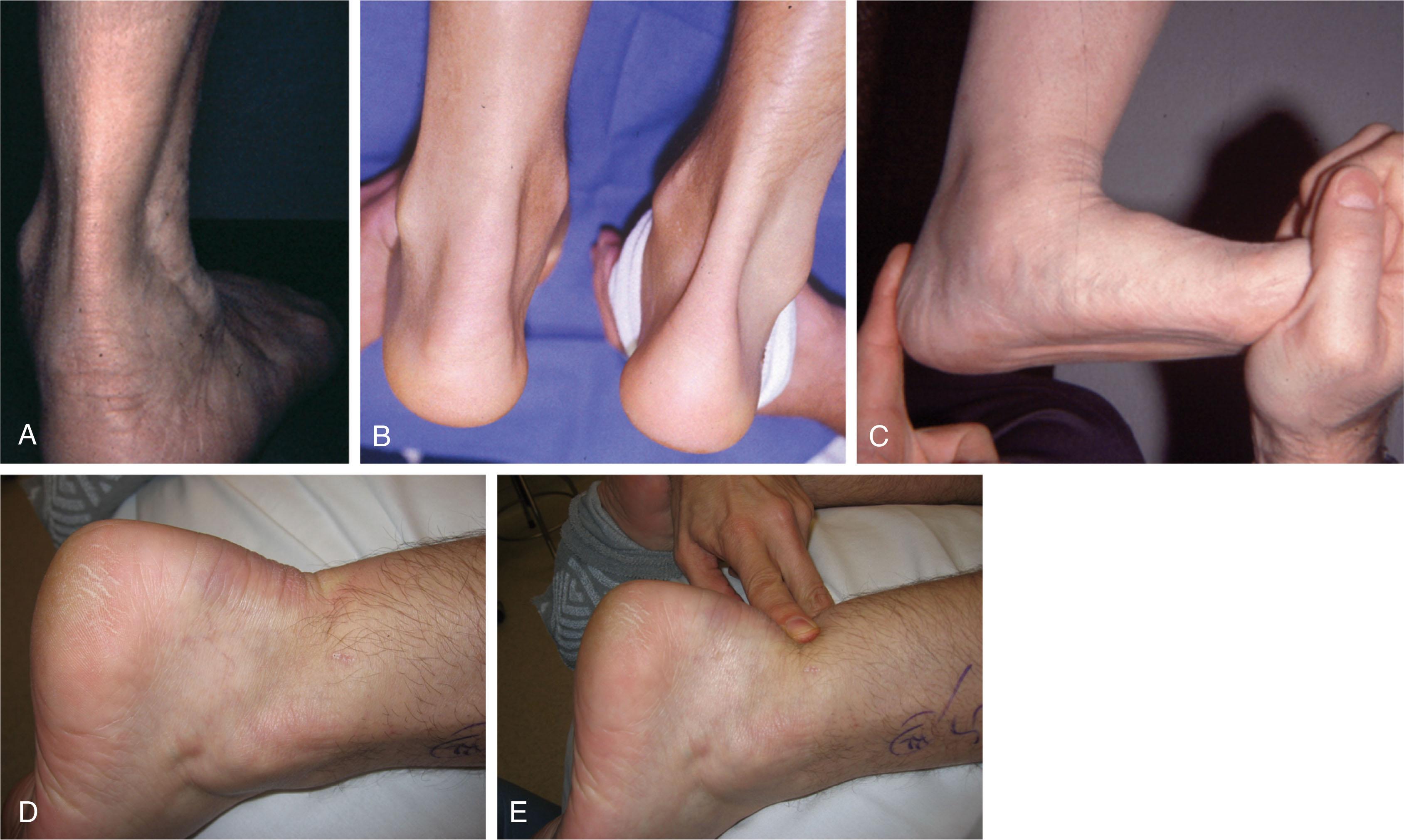 Fig. 2-9, Achilles tendon. A , The normal tendon is examined from behind. B , Tendinosis is seen in the Achilles tendon on the left. C , Excursion of the ankle joint is noted. A defect in the Achilles tendon after a rupture is observed (D) and palpated (E) on examination.