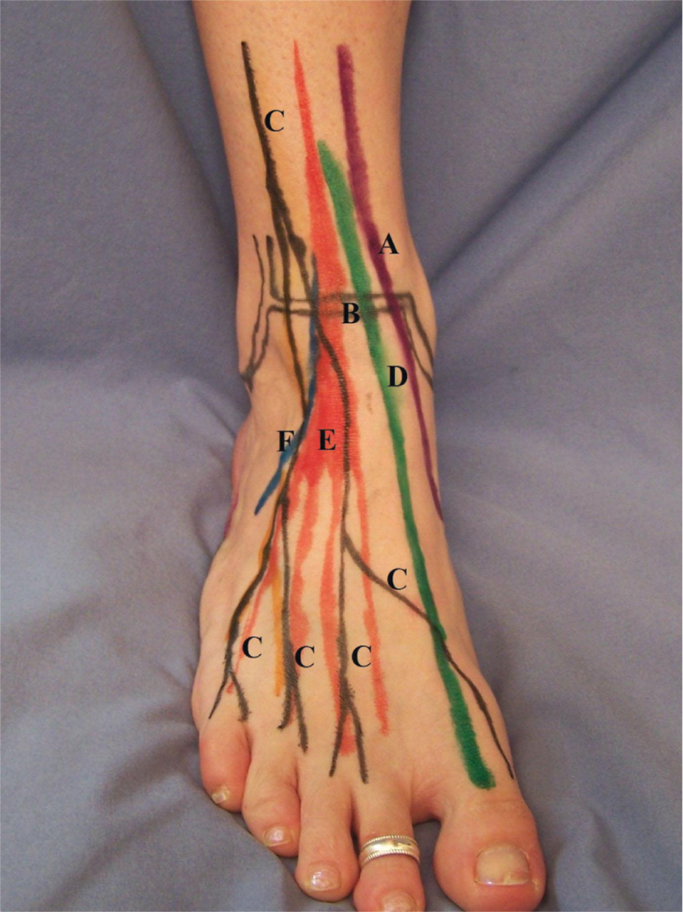 Fig. 2-10, Anterior ankle. A , Anterior tibialis tendon; B , anterior ankle joint; C , branches of the superficial peroneal nerve; D , extensor hallucis longus; E , extensor digitorum longus; F , peroneus tertius.
