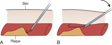 Fig. 28.3, Flattening the needle against the skin will often allow the wire to negotiate plaque adjacent to the puncture site.