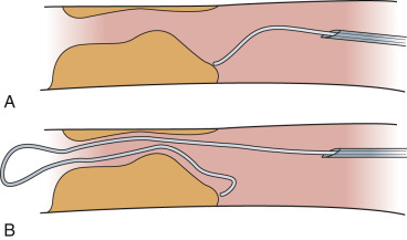 Fig. 28.4, The very floppy tip of the Bentson wire will negotiate plaque with minimal risk of dissection.