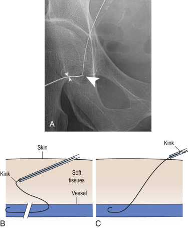 Fig. 28.5, (A) If the catheter (small arrowheads) is difficult to advance through the skin, the wire may have kinked (large arrowhead). (B) Schematic view. (C) The wire is pulled back until the kink lies outside the skin.