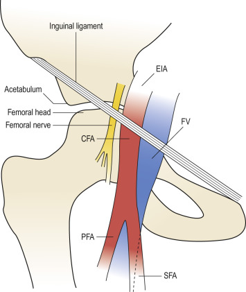 Fig. 28.6, The femoral anatomy.