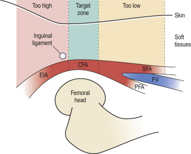 Fig. 28.7, Target puncture zone in the common femoral artery (CFA).