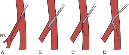 Fig. 28.8, Antegrade common femoral artery (CFA).