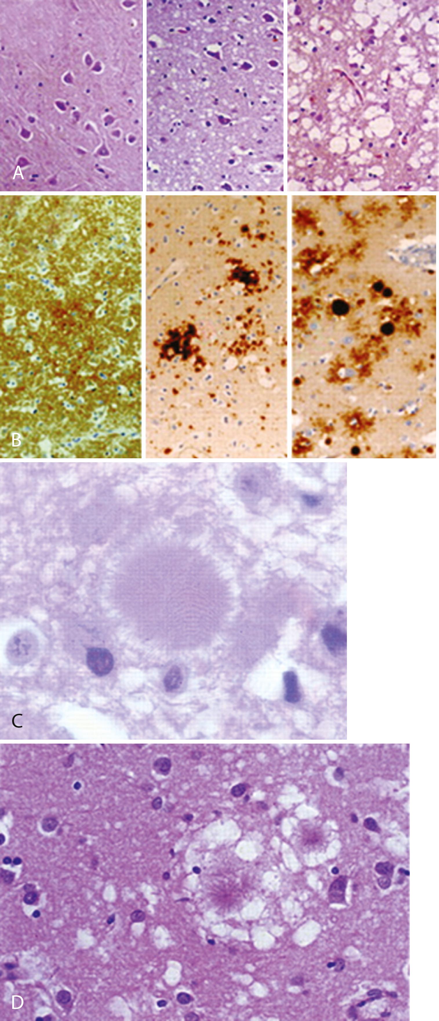 Fig. 94.4, Neuropathology of Prion Disease.