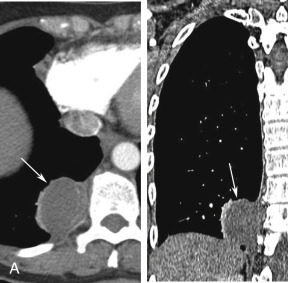 Figure 34.11, Intrapleural bronchogenic cyst in a 59-year-old woman. (A) Axial and coronal postcontrast chest CT images revealing a complex right paravertebral cystic lesion (arrows). It is difficult to discern whether the mass resides in the paravertebral mediastinum and represents a cystic nerve sheath tumor (cystic schwannoma), or whether it resides in the pleural space and represents an extrapleural sequestration or a complex intrapleural bronchogenic cyst. (B) Axial in-phase T1-weighted and coronal single-shot fast-spin echo T2-weighted MR images reveal the septated cystic lesion to contain T1/T2-hyperintense fluid (proteinaceous or hemorrhagic). The axial T1-weighted image nicely demonstrates the preserved right paravertebral fat stripe (arrow) , proving the mass to reside outside the posterior mediastinum. Its obtuse angles with the lung favor a pleural location. (C) Axial pre- and postprocessed subtracted postcontrast fat-saturated T1-weighted images reveal the irregularly thickened wall and septations of this lesion to enhance. The absence of a systemic arterial supply, in conjunction with the MRI findings, are compatible with a complex intrapleural bronchogenic cyst, as proven at surgery.