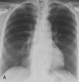 Figure 34.12, Pericardial cyst in a 66-year-old woman. Posteroanterior (A) and lateral (B) chest x-rays reveal a fairly lucent, dextroconvex right cardiophrenic angle mass. The tissue composition of this mediastinal mass is unclear by chest radiography and may be fluid, fatty, or other soft tissue composition. (C) Coronal single-shot fast spin-echo T2-weighted, sagittal single-shot fast-spin echo fat-saturated T2-weighted (D), and precontrast (E) and postcontrast (F) ultrafast three-dimensional gradient echo, fat-saturated T1-weighted images, revealing a homogeneously T1-hypointense, markedly T2-hyperintense, nonenhancing right cardiophrenic angle mass with a barely perceptible wall. Bandlike enhancing tissue along the anterosuperior aspect of the mass represents compressive atelectasis. The patchy low T2 signal in the mass on the coronal image represents proton spin dephasing within the jiggling, or secondarily pulsating, fluid because of the adjacent beating heart.