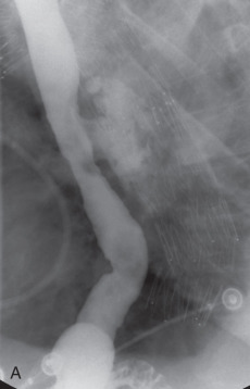 Figure 34.2, A 64-year-old man status post thoracic endovascular aortic repair of a nonruptured thoracic aortic aneurysm complicated by a polymicrobial abscess and persistent aortoesophageal fistula. (A) Contrast esophagram. (B) Sagittal chest CT scan with IV contrast. (C) Axial noncontrast chest CT scan revealing an aortoesophageal fistula.