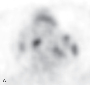 Figure 34.4, 18 FDG-PET–positive thymic hyperplasia and lymph nodes of sarcoidosis in a 42-year-old woman. (A) 18 FDG-PET–avid thymic tissue and middle mediastinal lymph nodes of sarcoidosis. (B) Noncontrast chest CT scan revealing excess soft tissue in the thymic bed for age. In-phase (C) and opposed-phase (D) ultrafast gradient echo chemical shift MRI reveals marked suppression of the thymic tissue on the opposed-phase image (chemical shift ratio = 0.4), proving the excess thymic tissue to contain microscopic or intravoxel fat and to therefore represent thymic hyperplasia.