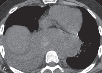 Figure 34.6, Large hemorrhagic, undifferentiated small round cell sarcoma arising from the middle mediastinum in a 24-year-old man with a 3-week history of dyspnea and palpitations. (A) Axial and coronal images from chest CT with IV contrast revealing a large, heterogeneous middle mediastinal mass and associated right pleural effusion. It is unclear whether this tissue is primarily hemorrhagic or solid and impossible to be certain where the solid components lie. (B–E) Coronal breath-hold single-shot, fast spin-echo, T2-weighted, precontrast ultrafast gradient echo (GRE), fat-saturated T1-weighted, postcontrast ultrafast GRE, fat-saturated, and postcontrast, postprocessed subtracted MRI scans, respectively, revealing the heterogeneous T1/T2 signal mass to be mixed hemorrhagic, necrotic, and solid. The postprocessed subtracted image clearly demonstrates the enhancing solid components and provides the endoscopist with important information—that subcarinal bronchoscopic biopsy should yield diagnostic tissue.