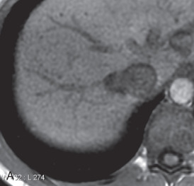 Figure 34.7, A 4-mm endometrioma along the right posterolateral hemidiaphragmatic pleura of a 24-year-old woman with pleuritic chest pain during menses over the past 2 years. Axial (A), coronal (B), and sagittal (C) ultrafast three-dimensional gradient echo, fat-saturated T1-weighted MRI scans revealing a tiny, T1-hyperintense, round, well-circumscribed lesion that appeared during menses when the patient was symptomatic. This lesion was not identifiable on an earlier MRI scan when this patient was between menstrual cycles.