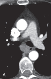 Figure 34.8, Esophageal leiomyoma in a 63-year-old woman. (A) Axial chest CT scan demonstrating a right midparaesophageal mass of soft tissue attenuation. Its tissue composition is indeterminate by CT and may be cystic or solid. (B and C) Axial breath-hold in-phase T1-weighted and cardiac-gated double inversion recovery, T2-weighted MRI scans, respectively, reveal the lesion to be of low-intermediate T1 and T2 signal, favoring the presence of smooth muscle, collagenous, and/or fibrous material. Axial breath-hold precontrast (D) and postcontrast (E–G) three-dimensional ultrafast gradient echo fat-saturated, T1-weighted 20-second, 1-minute, and 5-minute MRI scans reveal very mild, gradual enhancement of this solid lesion. The MRI features and location are most consistent with an esophageal leiomyoma, as proven by a subsequent endoscopic fine needle biopsy.