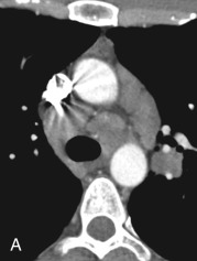 Figure 34.9, The dark lymph node sign of sarcoidosis. Matched axial contrast-enhanced chest CT (A, C) and cardiac-gated double inversion recovery T2-weighted MRI images (B, D) reveal the noncalcified lymphadenopathy on CT at two distinct axial levels to exhibit areas of low T2 signal on MRI, compatible with fibrotic changes observed in old granulomas—in this case, sarcoidosis.