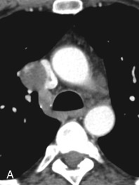 Figure 34.10, Hemangioma in the middle mediastinum of a 57-year-old man. (A) Axial chest CT scan revealing a 30-HU, round, well-circumscribed lesion compressing and indenting the superior vena cava, with a peripheral hyperattenuating focus, whether calcification or focal enhancement. (B) Axial in-phase ultrafast gradient echo (GRE) T1-weighted and cardiac-gated T2-weighted MRI (C) scans reveal the lesion to be mildly and homogeneously T1-hyperintense and T2-hyperintense. (D–G) Axial pre- and postcontrast ultrafast three-dimensional GRE fat-saturated T1-weighted images at 20 seconds, 1 minute, and 5 minutes reveal the lesion to demonstrate peripheral nodular enhancement, with partial fill-in over time. The signal characteristics and dynamic contrast enhancement pattern of this lesion are compatible with a hemangioma, with the diagnosis proven at surgery; the surgery was performed secondary to concern for eventual superior vena cava syndrome.