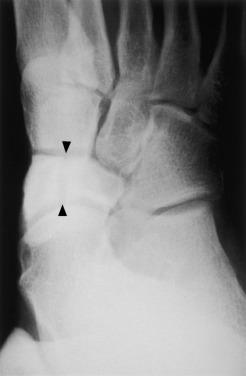 Fig. 5.2, An oblique radiograph of the tarsal navicular demonstrates a stress fracture.