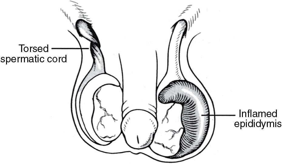 Fig. 143, Rotation of the right testicle in a torsion; an inflamed epididymis of the left testicle.