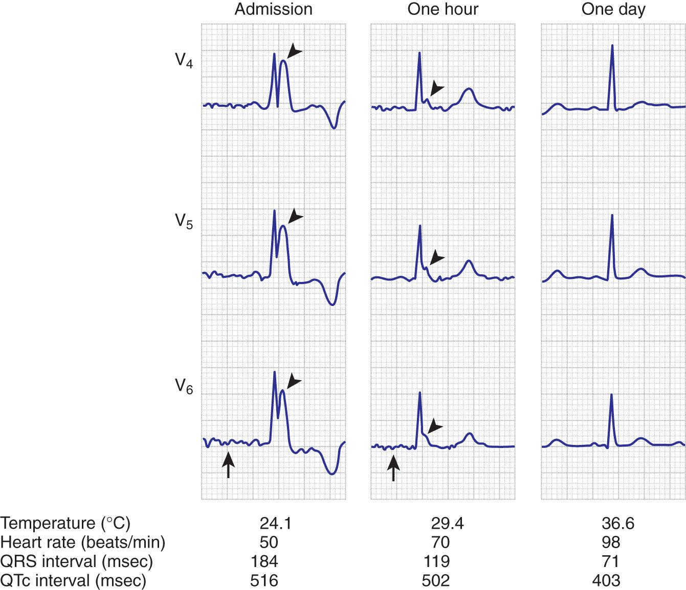 Figure 65.3, In severe hypothermia, the electrocardiogram (ECG) exhibits marked elevation of the J deflection, so-called Osborne waves (arrowheads). The height of the J wave is proportional to the degree of hypothermia, and this finding is usually most marked in the midprecordial leads. This ECG is from a patient with sinus bradycardia, but in approximately half the patients with a temperature below 32°C (89.6°F), slow atrial (arrows) fibrillation develops, a rhythm that usually converts spontaneously with rewarming.