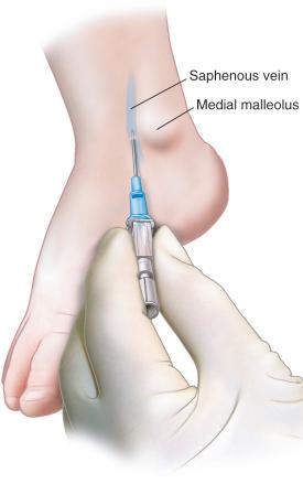 FIGURE 49.1, Long saphenous vein cannulation.