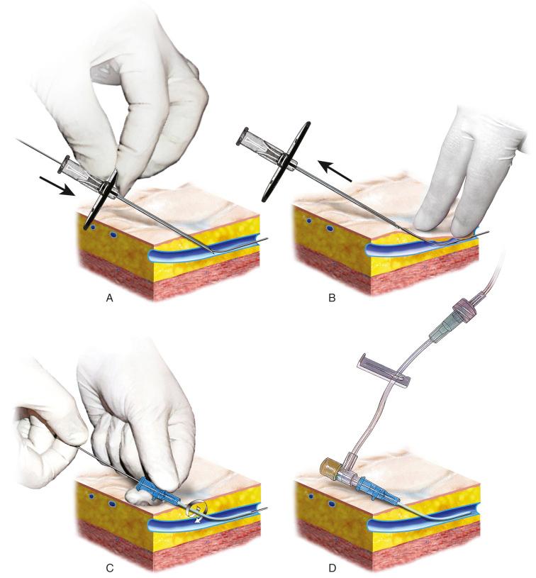 FIGURE 49.2, A, Seldinger technique for catheter placement. The needle is inserted into the target vessel, and the flexible end of the guidewire is passed freely into the vessel. B, The needle is then removed, leaving the guidewire in place. C, The catheter is advanced with a twisting motion into the vessel. D, The wire is removed, and the catheter is connected to an appropriate infusion or monitoring device.