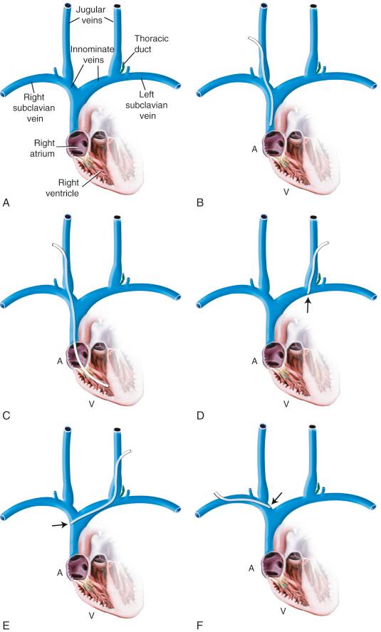 FIGURE 49.3, Proper and improper central venous pressure catheter placement. A, Normal vascular anatomy. B, Proper location for right internal jugular catheter (i.e., high right atrium or superior vena cava). C, Ventricular location of any catheter is dangerous and contraindicated. D, A short left-sided internal jugular catheter may erode through the innominate vein ( arrow ). E, A left-sided internal jugular catheter striking the lateral wall of the superior vena cava ( arrow ) may erode through it and must be partially withdrawn or advanced. F, A short right subclavian catheter may strike the lateral wall of the innominate vein ( arrow ) and erode through it; this catheter should be advanced or withdrawn. G, Proper location for a right subclavian line. H, A short left subclavian line may erode through the superior vena cava ( arrow ); this catheter should be advanced or withdrawn. A, atrium; V, ventricle.