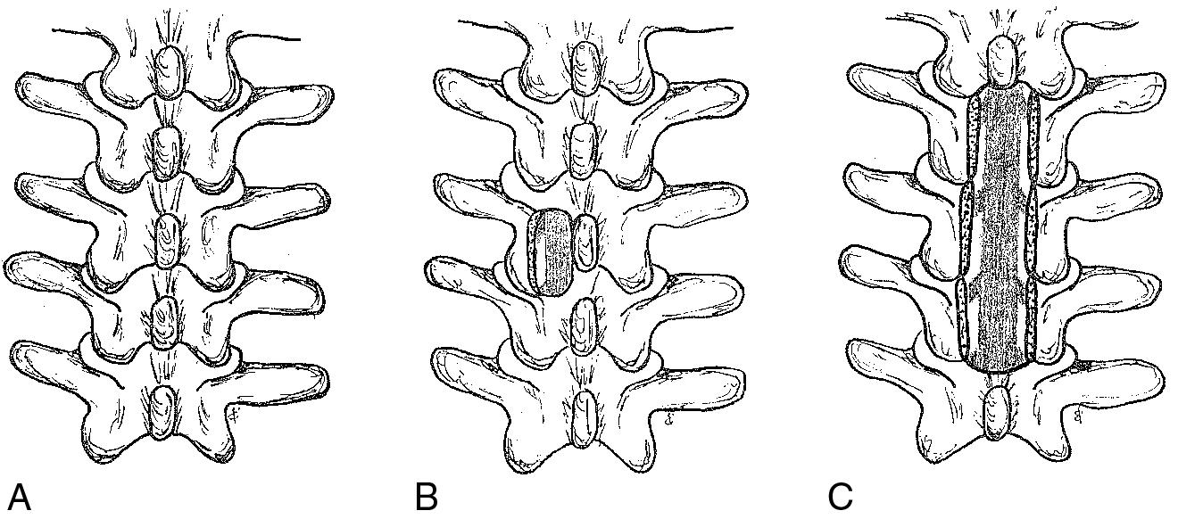 Fig. 24.1, Lumbar decompression. (A) Preoperative. (B) Laminotomy. (C) Laminectomy.