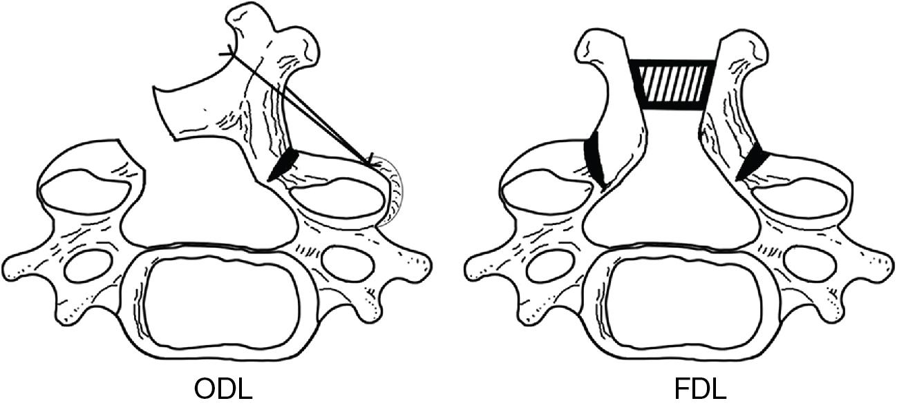 Fig. 24.2, Cervical laminoplasty methods. ODL , Open door laminoplasty; FDL , French door laminoplasty.