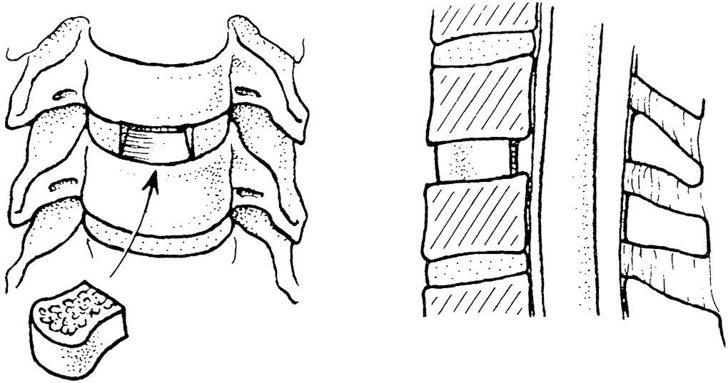 Fig. 24.3, Anterior cervical decompression: discectomy.