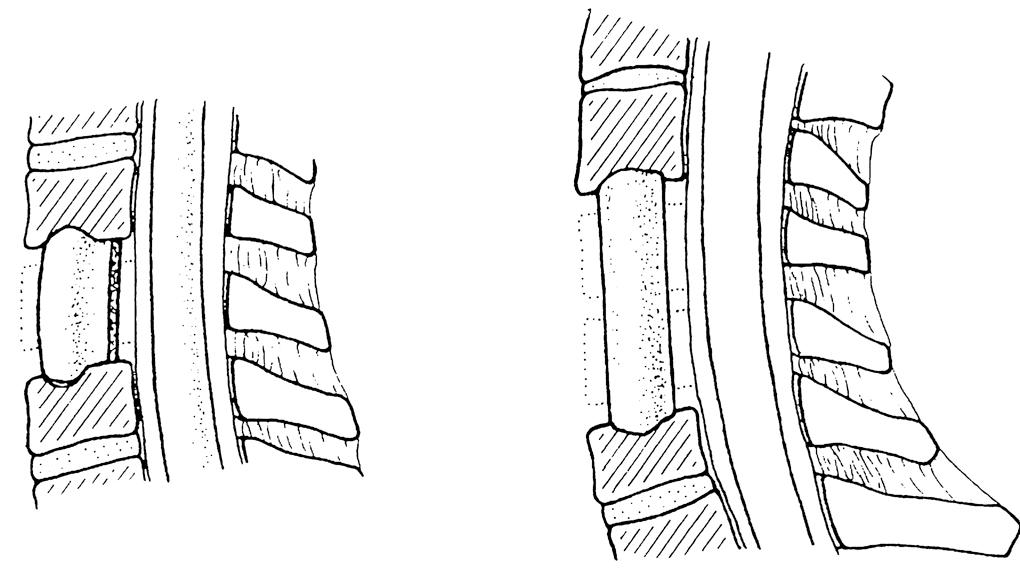 Fig. 24.4, Anterior cervical decompression: single-level and multilevel corpectomy.