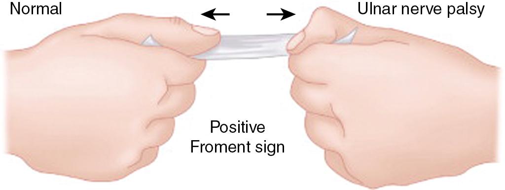 FIGURE 58.1, Positive Froment sign