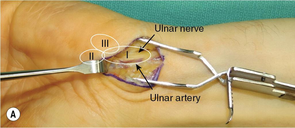 FIGURE 58.4, (A–B) The transverse volar ligament is released to reveal the underlying neurovascular bundle. Dissection is continued distally to release the motor (Zone 2) and sensory nerve (Zone 3) branches.