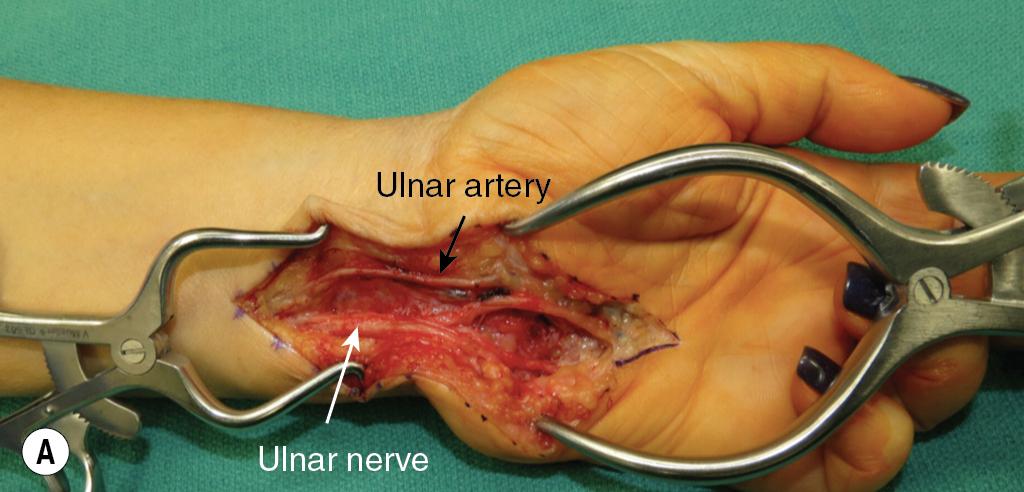 FIGURE 58.5, (A–B) Revision Guyon canal release with extensive neurolysis of ulnar nerve and branches into the palm.