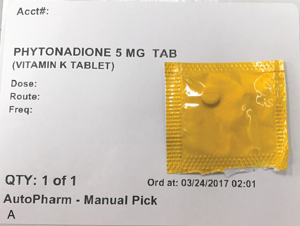 Figure 72.1, Anticoagulant and coagulopathy reversal agents. A, Oral vitamin K reverses the effect of vitamin K antagonists, such as warfarin. Onset of action ranges from hours to days. B, Intravenous vitamin K can be used in patients who require emergency procedures; however, onset of action is measured in hours, as the liver must regenerate coagulation factors. There is a risk of anaphylaxis with intravenous vitamin K, and it should be administered via slow infusion (over 20 to 60 minutes.) C, Fresh frozen plasma (FFP) can be used to reverse the effect of vitamin K antagonists in emergency situations. D, Prothrombin complex concentrates (such as the four factor PCC Kcentra [CSL Behring LLC., Kankakee, IL], pictured) provides rapid international normalized ratio correction and may be safer than FFP. PCCs can also be used to reverse the effects of direct thrombin inhibitors (e.g., dabigatran) and factor Xa inhibitors (e.g., apixaban). E, Platelet transfusions can be used to reverse the effects of antiplatelet medications such as aspirin or clopidogrel, and also to correct thrombocytopenias.