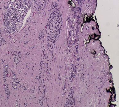 Figure 33.1, Histological appearance of a positive surgical margin with prostate cancer extending to inked margin or radical prostatectomy specimen.