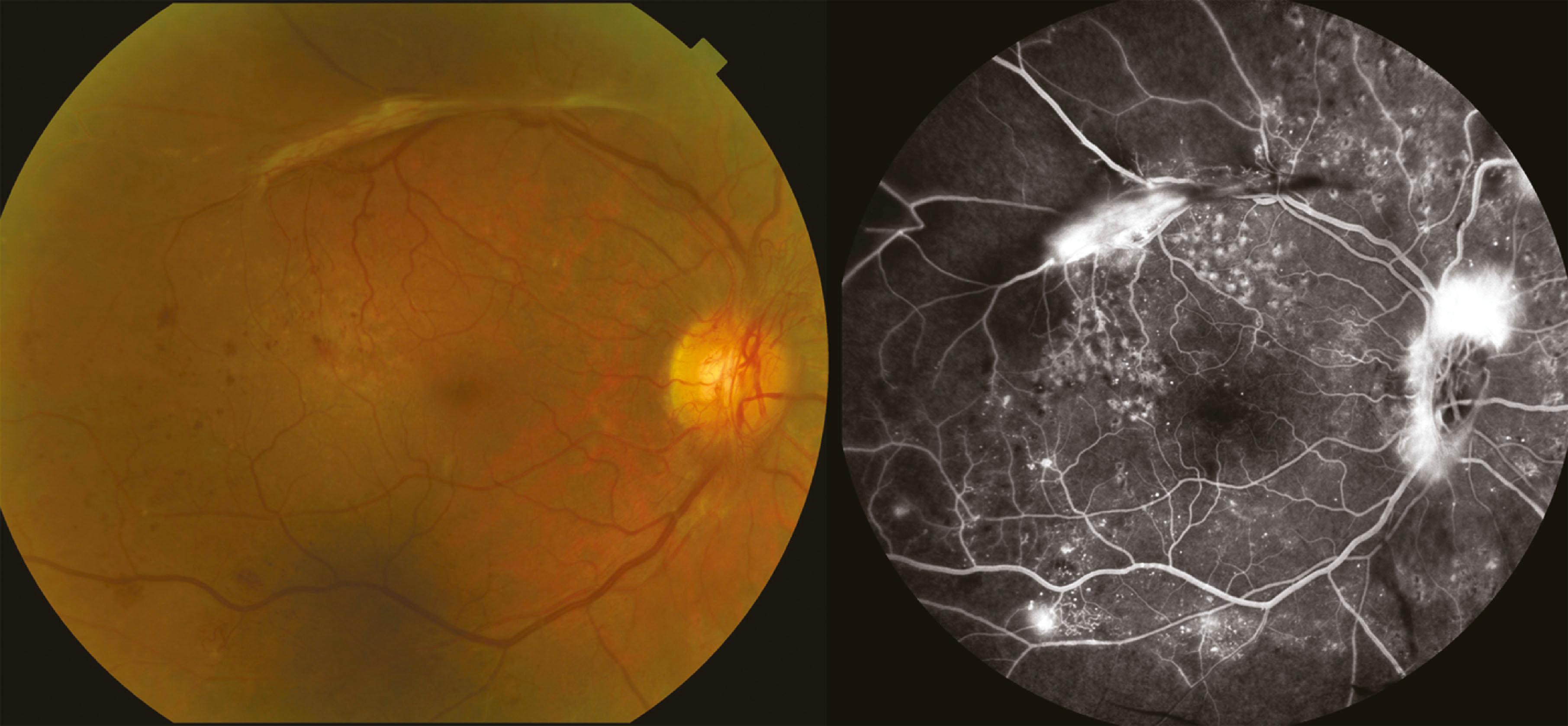 dm 2 with proliferative retinopathy icd 10