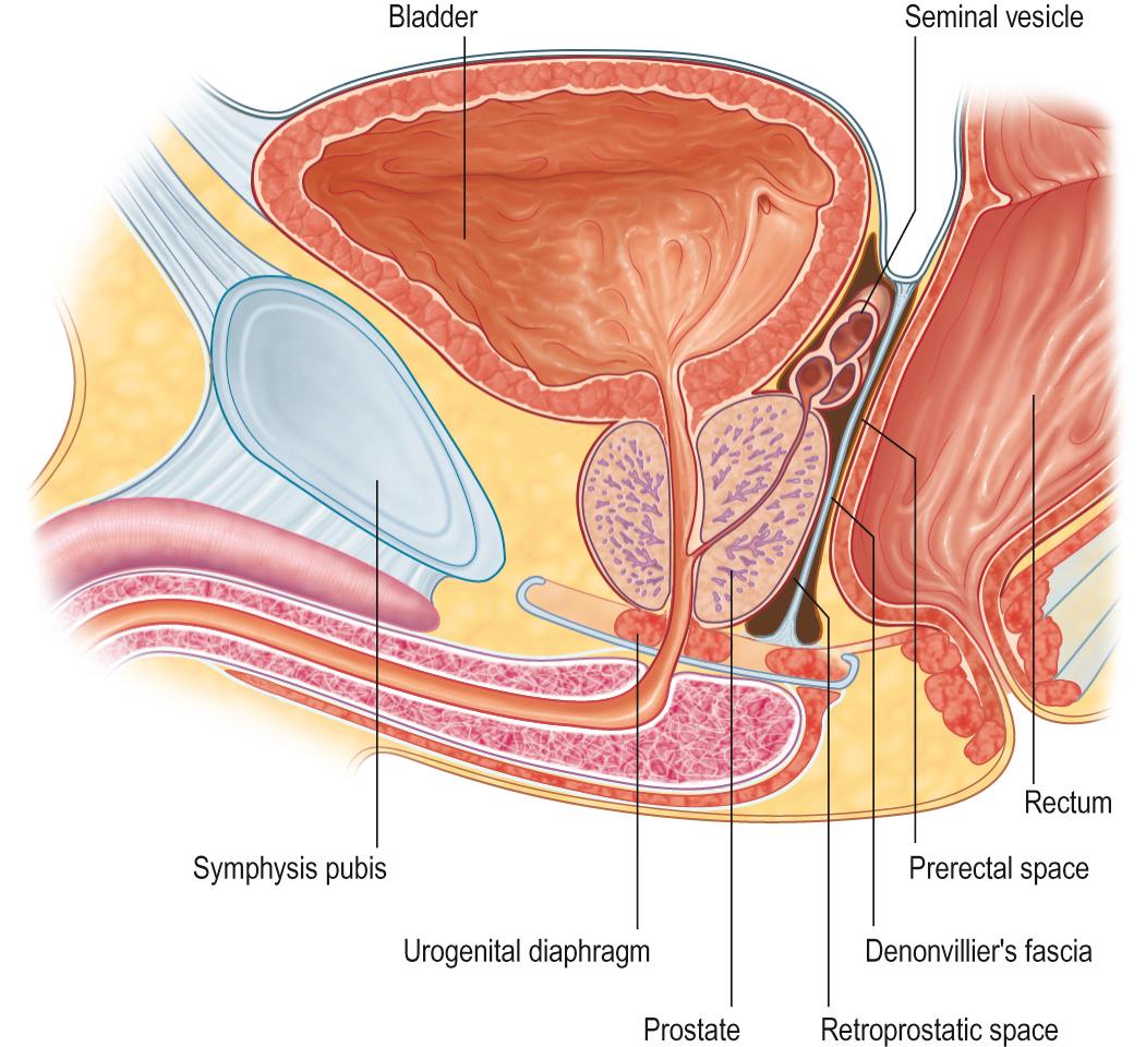 Fig. 73.3, The rectoprostatic fascia (Denonvilliers’ fascia) separates the retroprostatic and prerectal spaces.