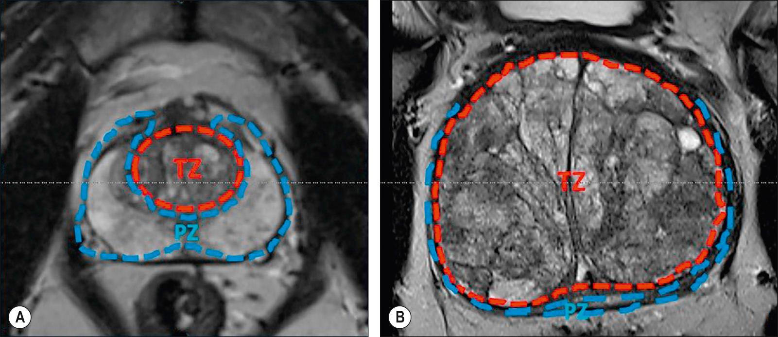 Fig. 73.5, A , The axial MRI appearance of a normal prostate. B , A prostate with significant benign prostatic hypertrophy. Note the gross enlargement of the transition zone (TZ indicated by dashed orange line) and compression of the peripheral zone (PZ indicated by blue dashed line).