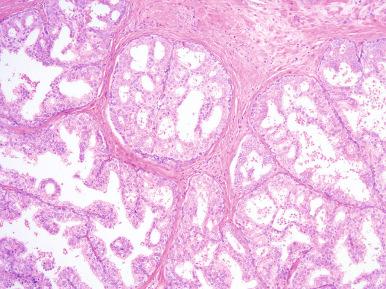 Figure 26.1, Normal central zone glands with typical “Roman bridge” formations and intraluminal papillary infolding.