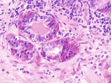 Figure 26.2, Eosinophilic Paneth-like neuroendocrine granules in benign prostatic glands.