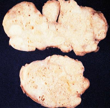 Figure 26.3, Gross appearance of nodular hyperplasia in material obtained from suprapubic prostatectomy. Note the multinodular appearance and the admixture of solid and microcystic areas.