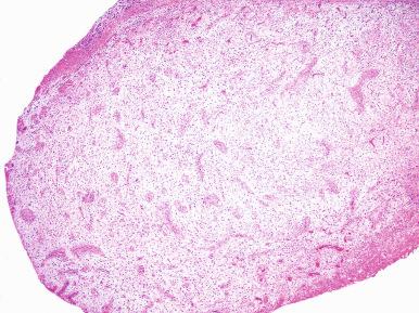 Figure 26.4, Stromal Nodule in Benign Prostatic Hyperplasia.