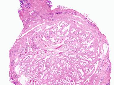 Figure 26.5, Nodular hyperplasia of prostate on TUR with detached well-circumscribed nodules of glands. TUR , Transurethral resection.