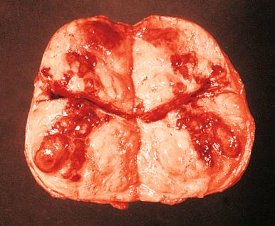 Figure 25.6, Gross Appearance of Infarct of Prostate.