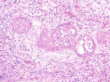 Figure 26.7, Prominent squamous metaplastic changes at the edge of a prostatic infarct. These are sometimes overdiagnosed as carcinoma.