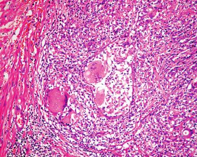 Figure 26.8, Nonspecific Granulomatous Prostatitis.