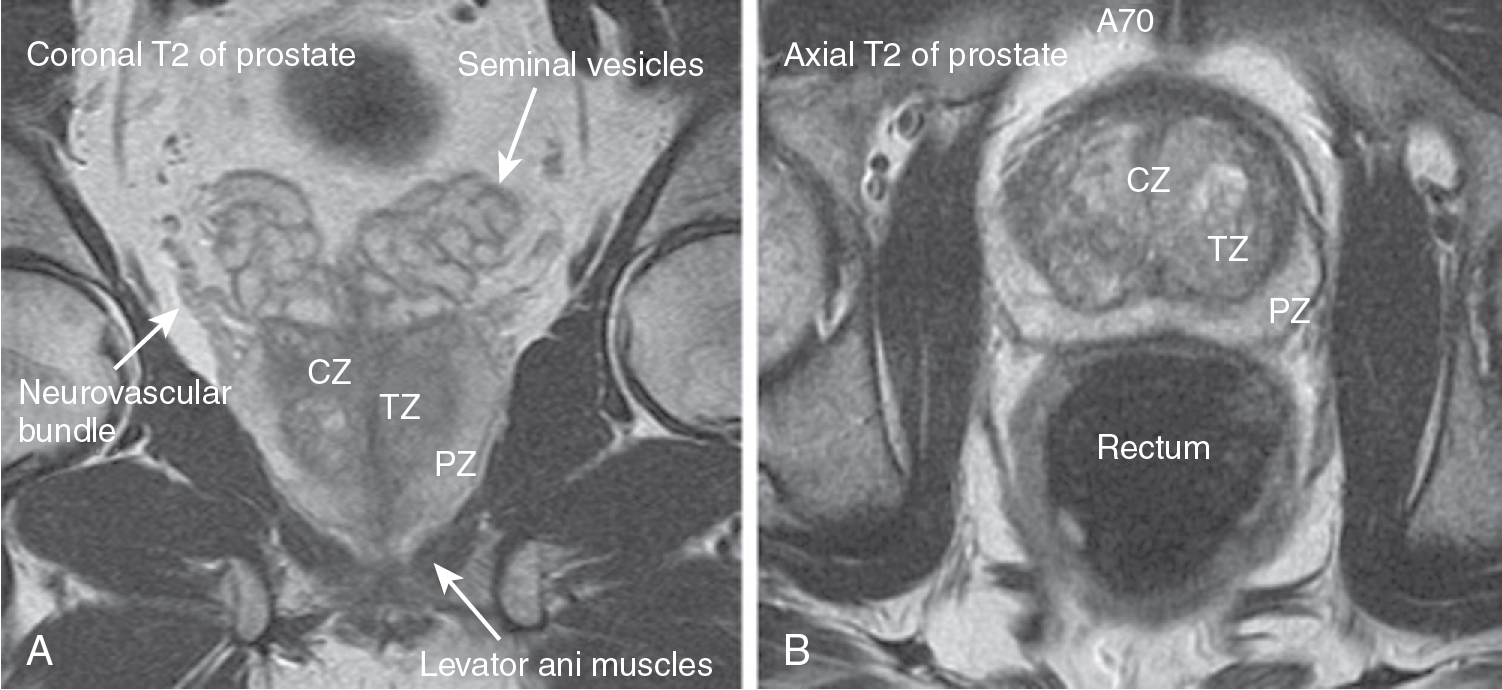 Fig. 29.1, Normal anatomy of the prostate on magnetic resonance imaging. A and B, Prostatic zonal anatomy is well seen on T2-weighted magnetic resonance imaging. The peripheral zone (PZ) is of intermediate to high signal intensity. This contrasts to the intermediate to low signal intensity of the transition zone (TZ) and central zone (CZ). The capsule is seen as having an outer band of low signal intensity, and the periprostatic venous plexus has high signal intensity.