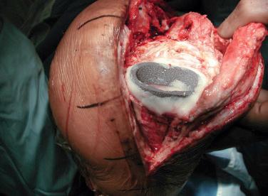 FIGURE 23A.3, The tibial metaphyseal fixation device is in place, reestablishing the mechanical platform for component placement.