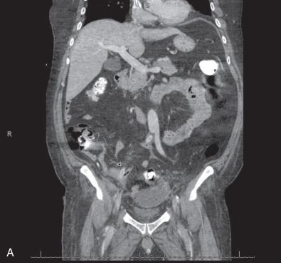 FIG 59.1, (A) Preoperative computed tomographic scan of patient presenting with infected aortic graft showing one limb of the aortobifemoral graft impaled through the terminal ileum (arrow). This type of injury can occur during tunneling of the graft limb. (B) Intraoperative image of prosthetic aortobifemoral graft limb that has pierced through the terminal ileum.